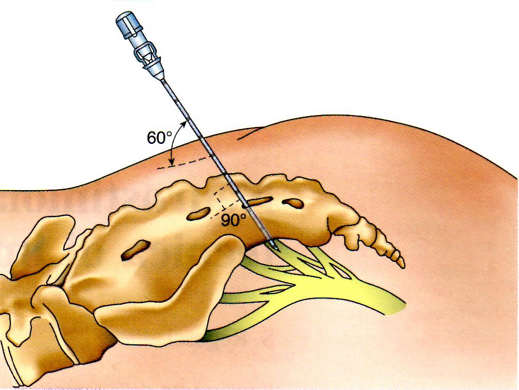 Neuro-modulazione sacrale